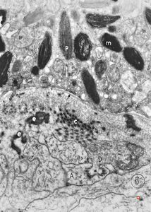 M,6m. | maxilla - melanotic progonoma (melanotic neuroectodermal tumor of infancy)